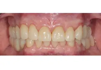 After image