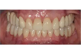 After image